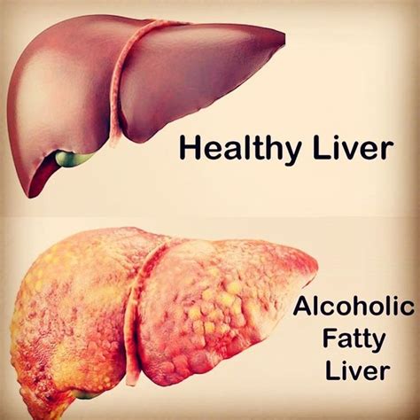 Medical Doctor On Instagram “healthy Liver Vs Alcoholic Fatty Liver