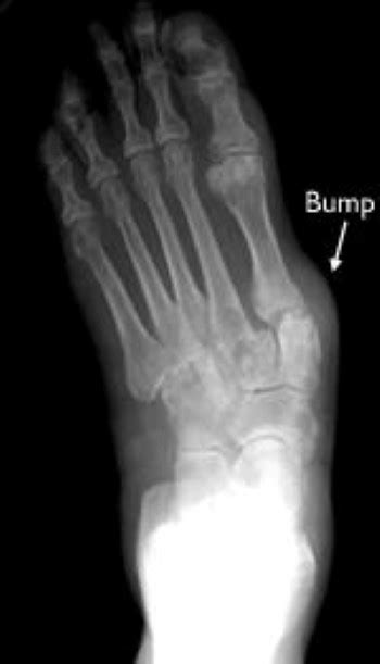 Rheumatoid Arthritis Within Foot And Ankle New Mexico Orthopaedic