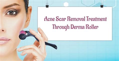Acne Scar Removal Treatment Through Derma Roller
