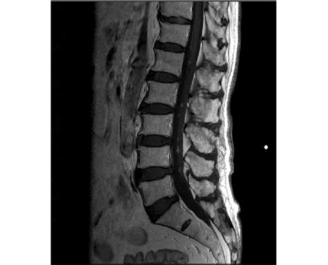 Sagittal View Of The Lumbar Spinal Magnetic Resonance Imaging With