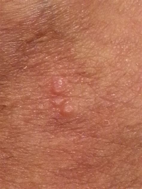 Feigwarzen entstehen durch eine infektion mit dem humanen papillomvirus (hpv). Sind das Feigwarzen? (Pickel, Hodensack)