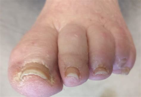 Listerine For Toenail Fungus Causes Home Remedies And Best Treatment