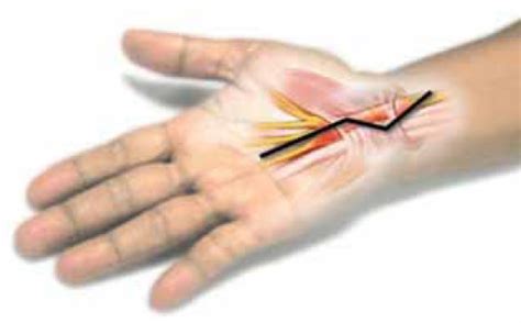 The New Wave Of Carpal Tunnel Syndrome Cts Surgery