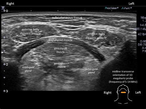 Salivary Ultrasound Standardized Diagnostic Approach And Report Iowa