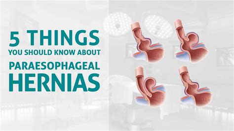 Ais Channel · 5 Things You Should Know About Paraesophageal Hernias
