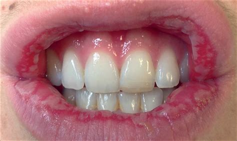 Swollen Lips Symptom Of Covid Lipstutorial Org