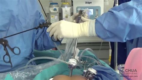 What Is Laparoscopic Surgery Minimally Invasive Surgery Key Hole