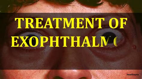Treatment Of Exophthalmos Bulging Eyes Youtube