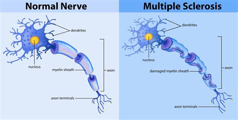 Multiple Sclerosis Important Things You Need To Know