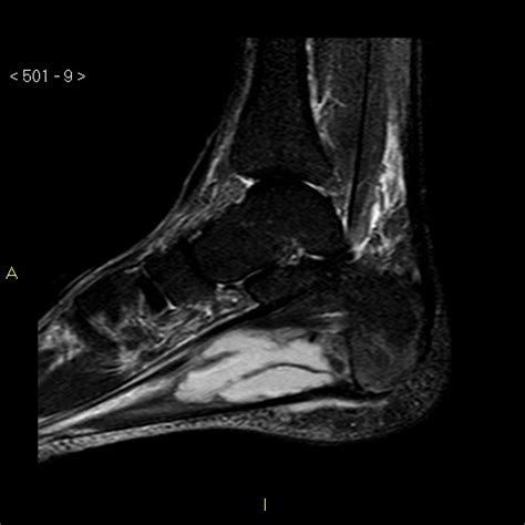The muscles lying within the medial group form a. Infectious plantar fasciitis (iatrogenic) | Image ...