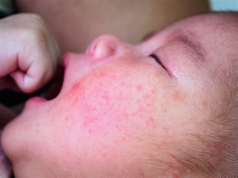 新生儿宝宝出湿疹了，宝爸宝妈该如何处理？小豆苗疫苗助手