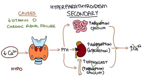 Hyperparathyroidism Symptoms Causes Risk Factors