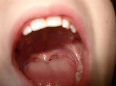 Tonsil Stones Heres How To Get Rid Of Them Without Hurting Yourself