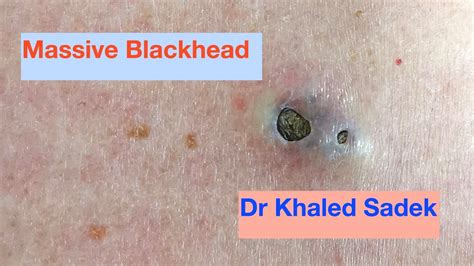 Massive 3 Year Old Blackhead Finally Comes Out Dr Khaled Sadek