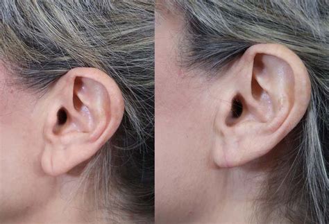 Earlobe Reduction Before And After Savannah Facial Plastic Surgery