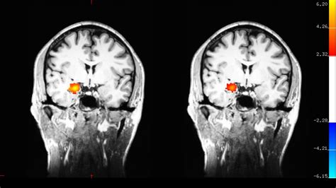Scientists Studied How It Seems To Change The Brain In Depressed Patients