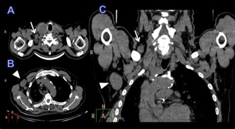 Ct Imaging In Axial A B And Coronal C Plane Lymph Open I