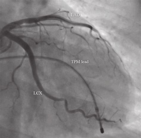 Right Anterior Oblique Coronary Angiographic View Showing No