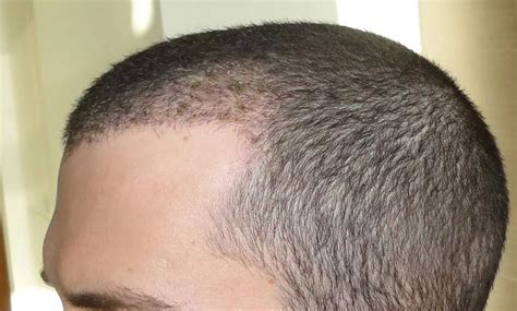 Can Be Noticed Shedding Of Hair Grafts After A Hair Transplant Newlyme