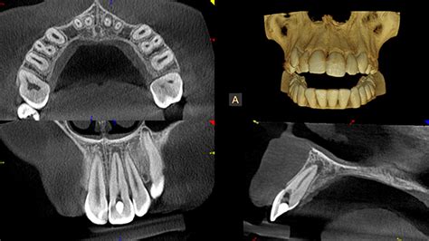 Cone Beam CT 3D Scan FiDi Endodontics NYC Endodontists Manhattan