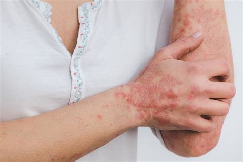 The Most Common Skin Rashes Causes And Treatments