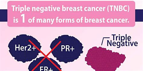 The type of breast cancer is determined by the presence or absence of receptors, proteins that live inside or on the surface of a cell and bind to something in the. There are Associations Between Obesity and Triple Negative ...