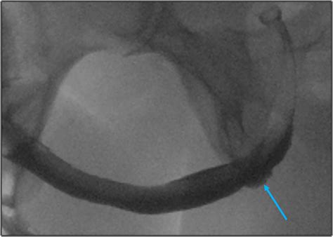 Anterior Urethral Strictures And Retrograde Urethrography An Update