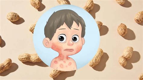 Two New Treatments Can Induce Peanut Allergy Remission In Children