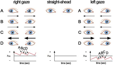 Bedside Examination Of The Vestibular And Ocular Motor System In