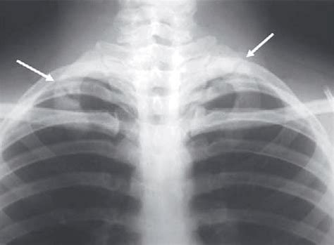 Figure 1 From Bilateral First Rib Fractures With Pseudoarthrosis In A