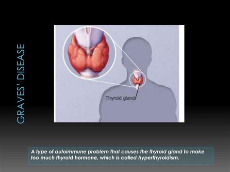 Ppt Graves Disease Powerpoint Presentation Free Download Id2491607