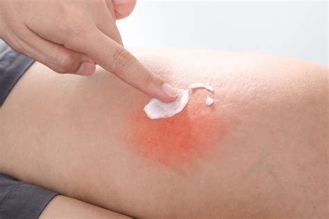 Ce Este Dermatita Atopica Cunoscuta Popular Ca Si Eczema Clinica