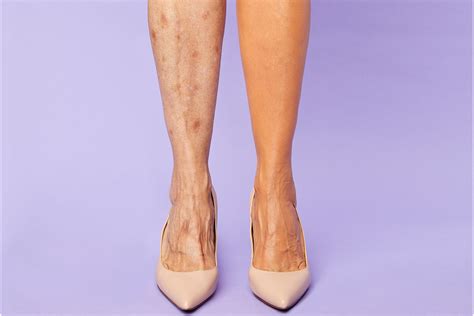 Tarte Just Launched A Body Concealer That Covers Unwanted Veins In Seconds Newbeauty