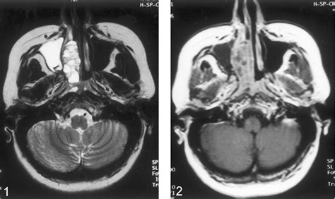 Sinonasal Ossifying Fibroma With Fluid Fluid Levels On Mr Images
