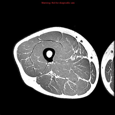 Upper Thigh Mri Anatomy Mri Of The Thigh Detailed Anatomy Superior