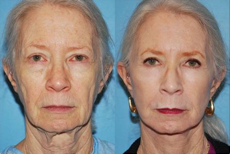 Before And After Pictures Chemical Peel Treatment Chicago Il Dr Sidle