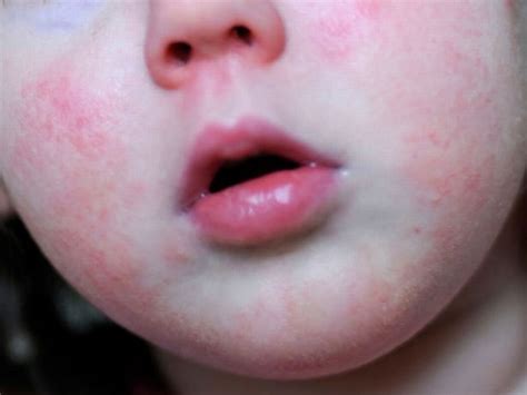 Scarlet Fever Cases Confirmed At Two North Wales Primary Schools