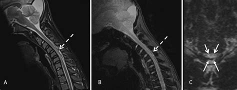 Flexion Position Cervical Spine Magnetic Resonance Imaging A