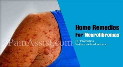 Home Remedies For Neurofibromas
