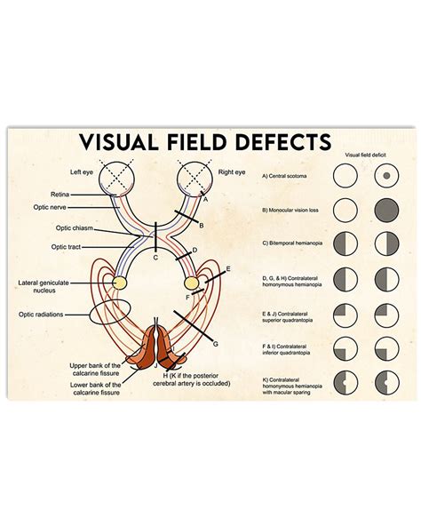 Visual Field Defects Poster Ophthalmology Poster Ophthalmologist