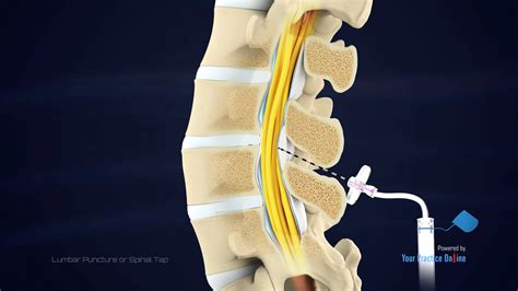 Lumbar Puncture Video Medical Video Library