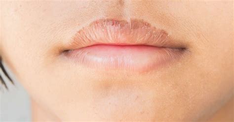 How To Heal Cracked And Chapped Lips