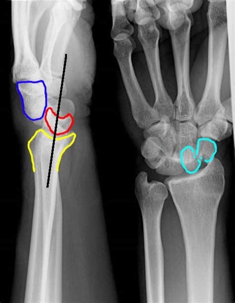 Perilunate And Lunate Dislocations Hand Wiki Nus