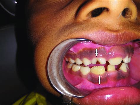 We did not find results for: Fused maxillary right deciduous central and lateral ...