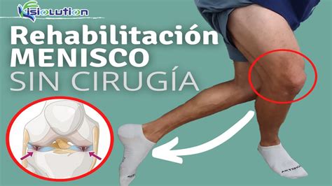 rotura de menisco rodilla reahbilitacion sin cirugia ejercicios y fisioterapia fisiolution