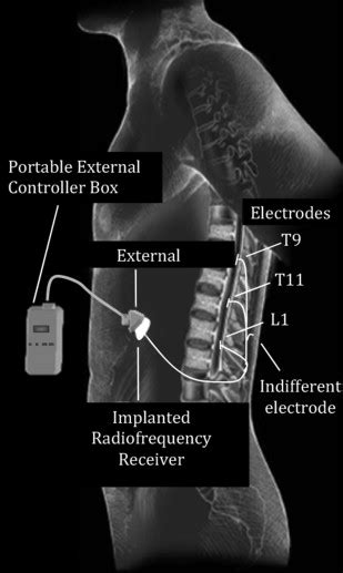 Diaphragmatic Pacing In Spinal Cord Injury Musculoskeletal Key