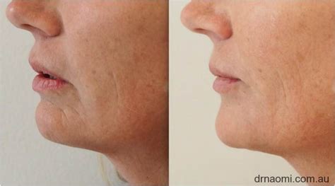 Dermal Filler To Improve Jowls Jawline And Sag In Lower Face Best Clinic Sydney For Dermal