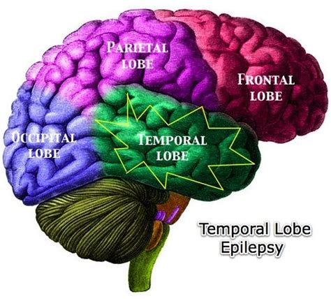 Pin By Fred Yeomans On Complexity Epilepsy Frontal Lobe Temporal
