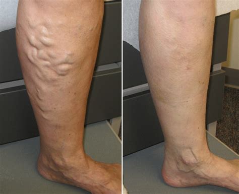Varicose Veins Treatment In Clark Daily Nutrition News