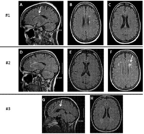 Mri Findings In The Brain Of Three Patients With Benign Multiple